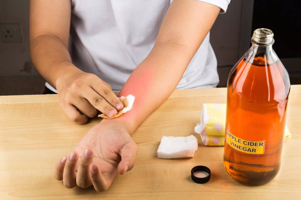 Apple cider vinegar for ringworm